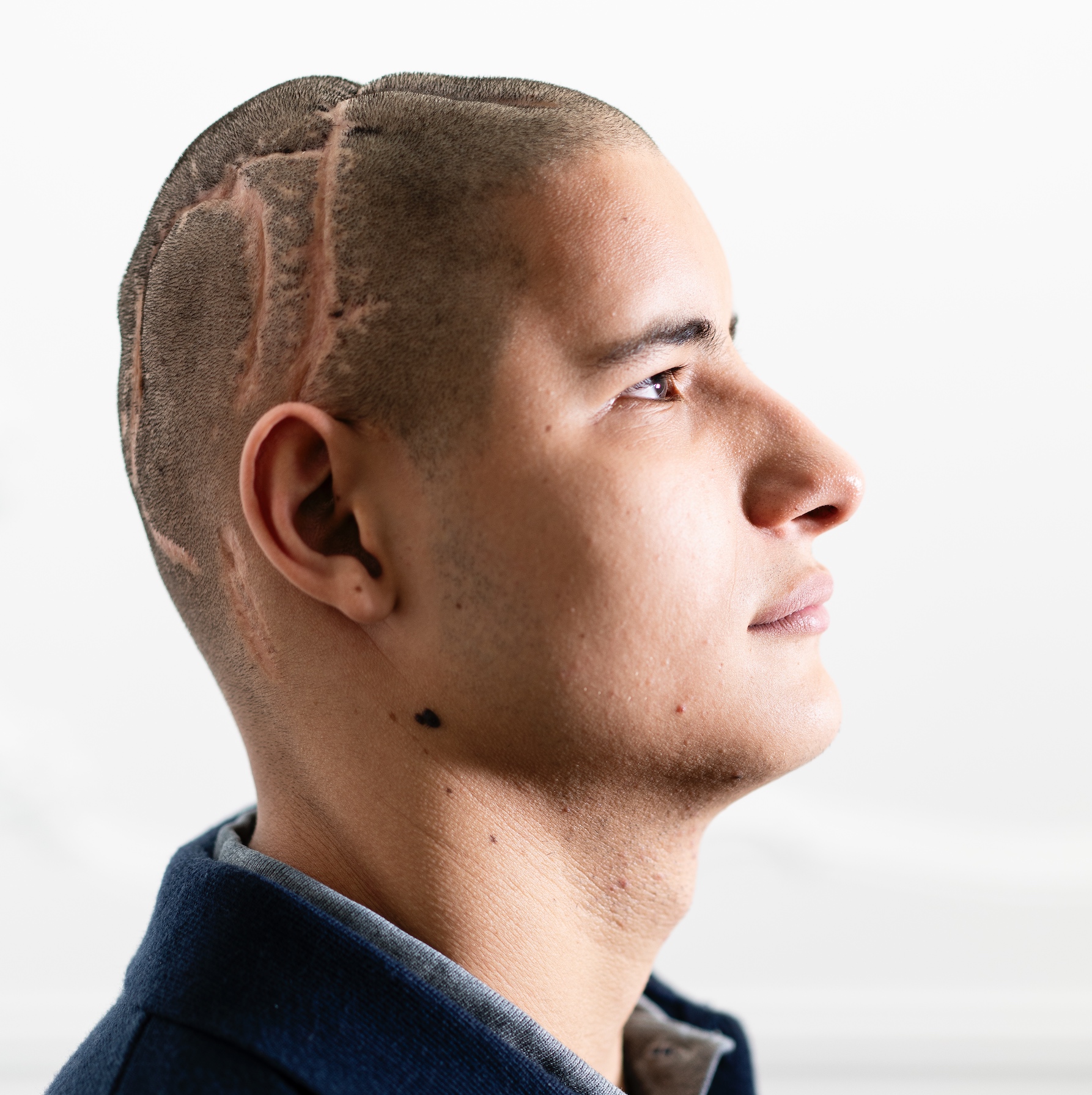 «Nací muerto. Me falta casi todo el cerebro, pero no dejo de luchar»